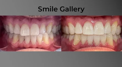 📸 Smile Gallery (Before & After Photos)